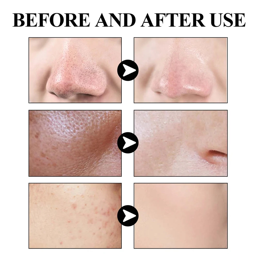 Blackhead Removal Mud Mask Oil Control Pore Care